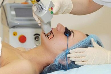Arten der Gesichtshautverjüngung mit Laser